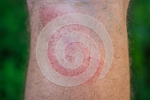 Migrating erythema after a tick bite on a man`s leg.
