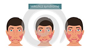 Mikulicz syndrome. Enlargement of the lacrimal and salivary glands