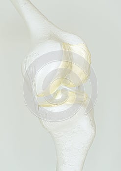 Mild osteoarthritis - stage 1- on the knee joint - high degree of detail - 3D Rendering