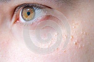 Milia (Milium) - pimples around eye on skin