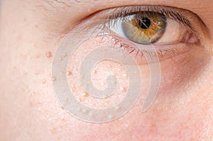 Milia (Milium) - pimples around eye on skin