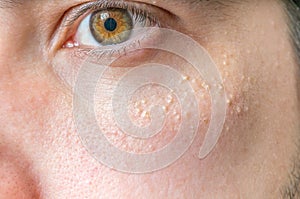 Milia (Milium) - pimples around eye on skin