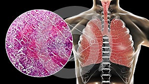 Miliary tuberculosis, illustration and light micrograph