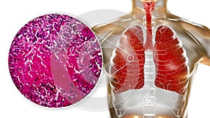 Miliary tuberculosis, illustration and light micrograph