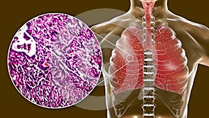 Miliary tuberculosis, illustration and light micrograph