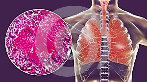 Miliary tuberculosis, illustration and light micrograph