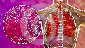 Miliary tuberculosis, illustration and light micrograph