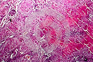 Miliary tuberculosis, light micrograph