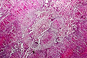 Miliary tuberculosis, light micrograph