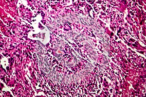 Miliary tuberculosis, light micrograph