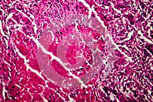 Miliary tuberculosis, light micrograph