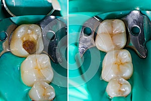 Mimicking Nature In Dentistry