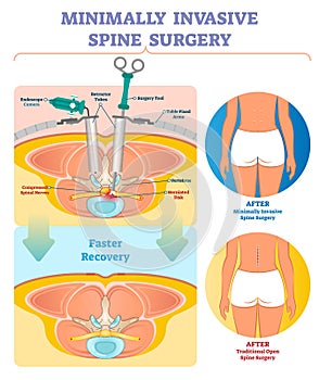 Minimally invasive spine surgery vector illustration. Labeled diagram.