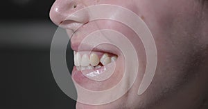 Misaligned Teeth with Prominent Canine Tooth Above the Dental Line