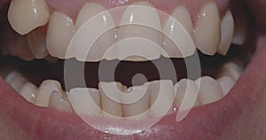 Misaligned Teeth with Prominent Canine Tooth Above the Dental Line