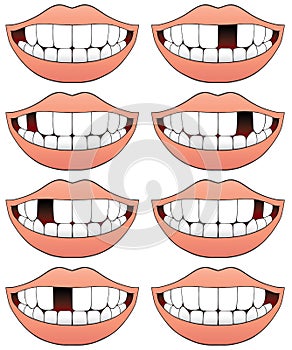 Missing Tooth Series