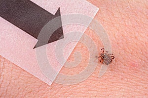 Mite on the skin. Danger of tick bite