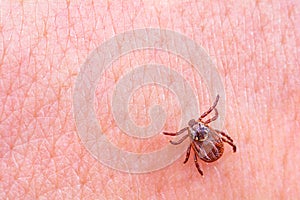 Mite on the skin. Danger of tick bite