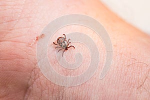 Mite on the skin. Danger of tick bite.