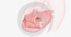 Mitral valve prolapse occurs when the heart contracts and the mi