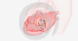 Mitral valve prolapse occurs when the heart contracts and the mi