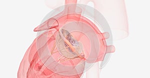 Mitral valve prolapse occurs when the heart contracts and the mi