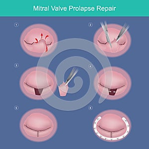 Mitral Valve Prolapse Repair. The method repair heart valve by surgery removed damaged or abnormal leaked segment and used photo