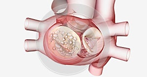 Mitral valve stenosis is the stiffening and narrowing of the hea