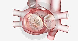 Mitral valve stenosis is the stiffening and narrowing of the hea