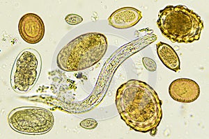 Mixed of helminths or parasitic worm in stool