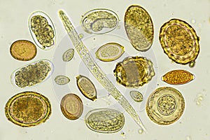 Mixed of helminths or parasitic worm in stool