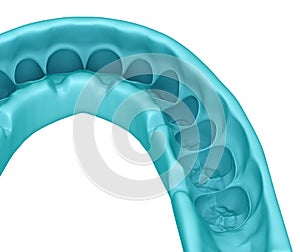 Mock-up dental key. Treatment Planning. Medically accurate tooth 3D illustration