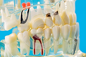 Mockup of a dental jaw with diseased teeth. Inflamed tooth canal, pulpitis and caries. Tartar, treatment and prevention