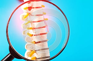 Model of the cervical spine with a compressed nerve root on a blue background under a magnifying glass. Concept of photo