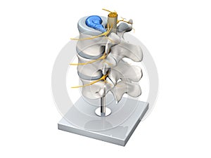 Model of a herniated disc of the lumbar spine. 3D Illustration photo