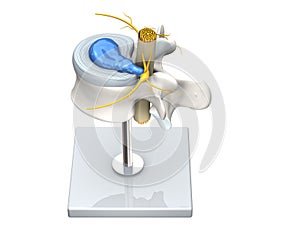 Model of a herniated disc of the lumbar spine, stenosis, slipped disc. 3D Illustration photo