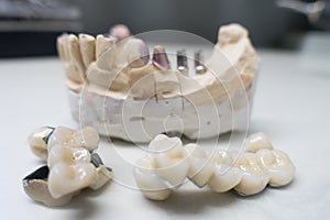 Model of the human jaw with dental implants