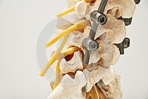 Model of instrument fixation of human lumbar spine model