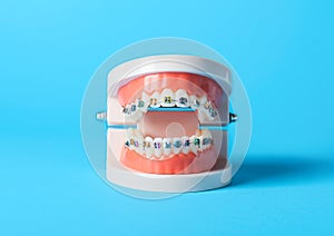 Model of jaw with braces on blue background