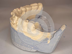 Model of plaster cast of lower teeth