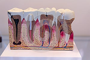 Model with samples of treatment and prosthetics of human teeth