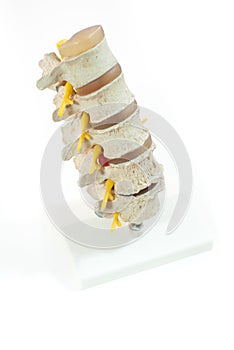 Model of spinal disc herniation