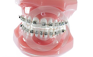 Model of Teeth with Braces