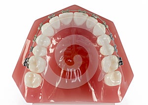 Model of Teeth with braces viewed from the top