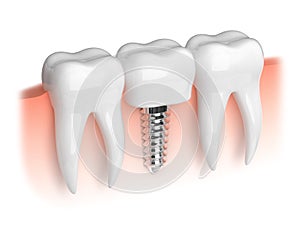 Model of teeth and dental implant