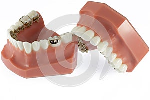 Model of Teeth with Lingual Braces