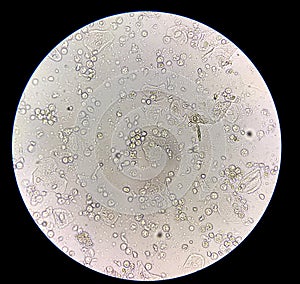 Moderate bacteria and white blood cells in patien bacteria urinary tract infection