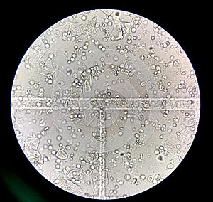 Moderate bacteria and white blood cells in patien bacteria urinary tract infection