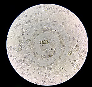 Moderate bacteria and white blood cells in patien bacteria urinary tract infection