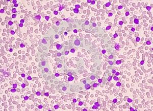Moderate blast cell of white blood cells in blood smear